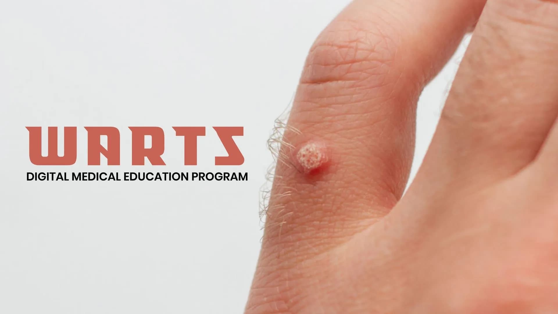 Warts Digital Medical Education Program - Czech