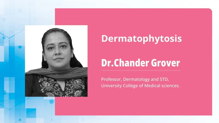 Dermatophytosis: Treatment Modalities and Recalcitrant Dermatophytosis