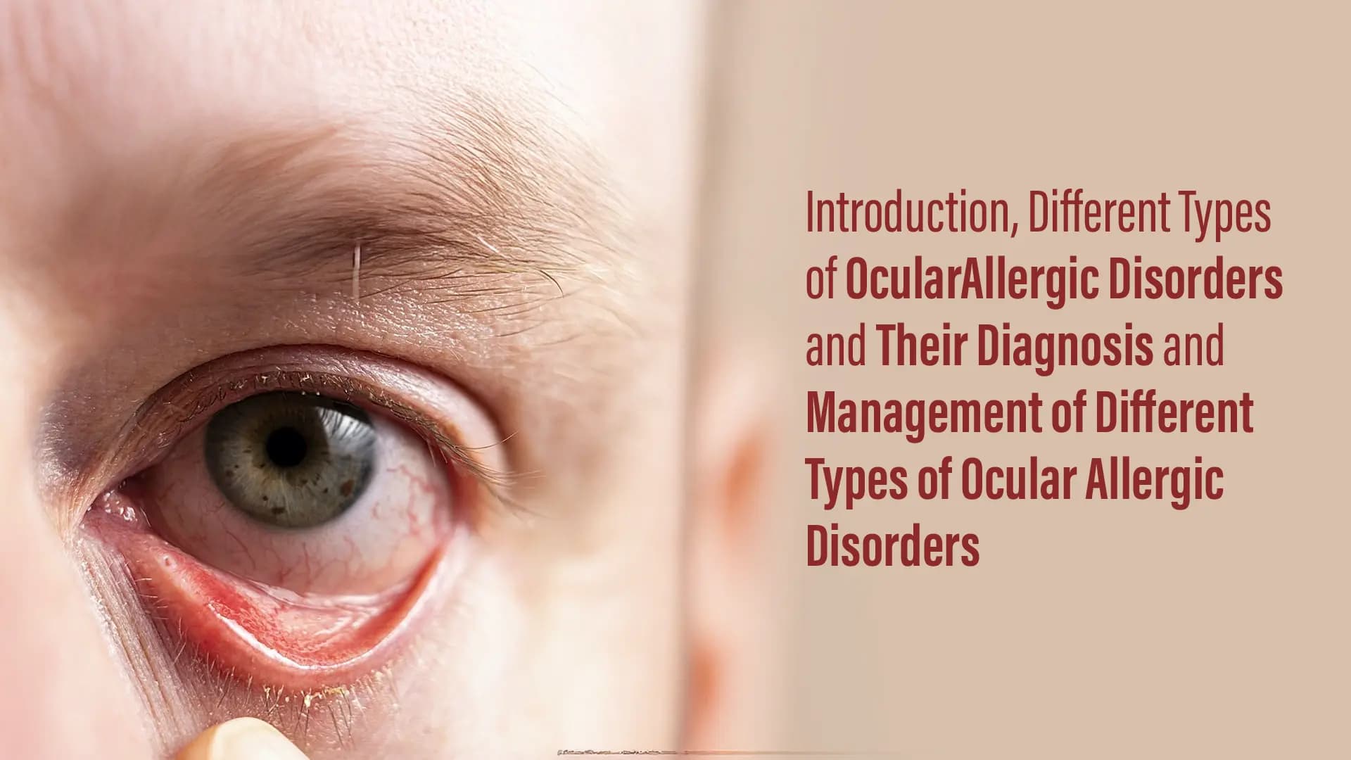 Introduction, Different Types of Ocular Allergic Disorders and Their Diagnosis and Management of Different Types of Ocular Allergic Disorders