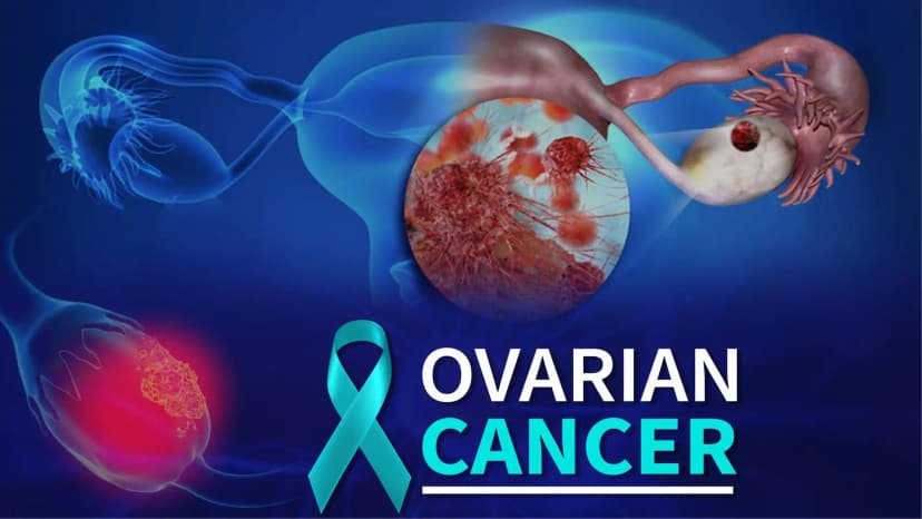 Diagnosing Ovarian Cancer – History, Clinical Examination Investigations and Imaging Studies	