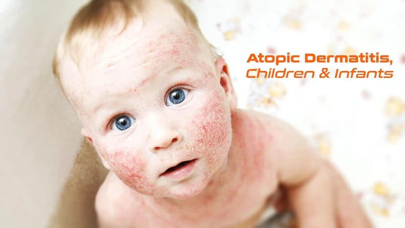Atopic Dermatitis: Children and Infants