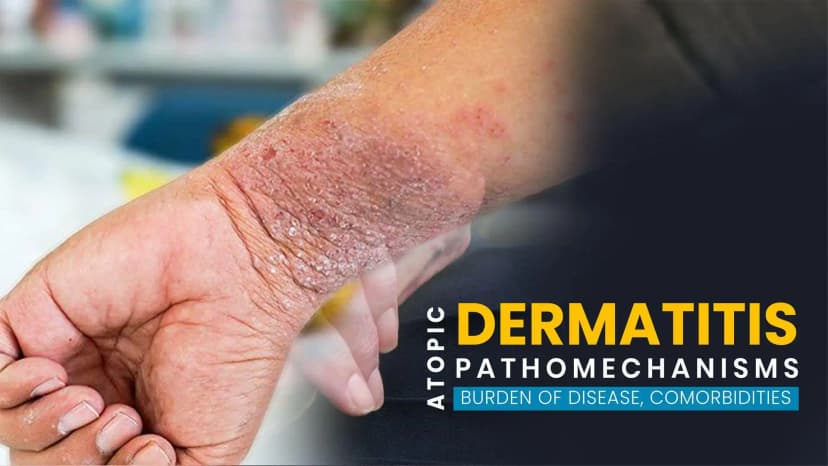 Atopic Dermatitis - Pathomechanisms, Burden of Disease, Comorbidities