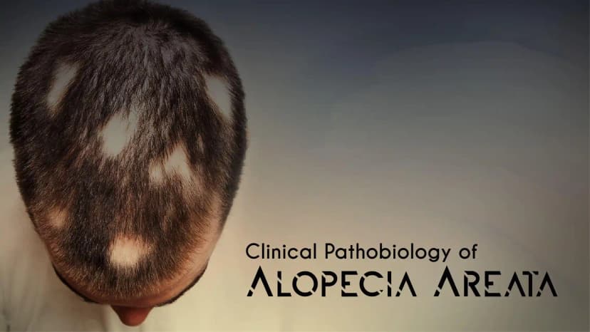 Clinical Pathobiology of Alopecia Areata
