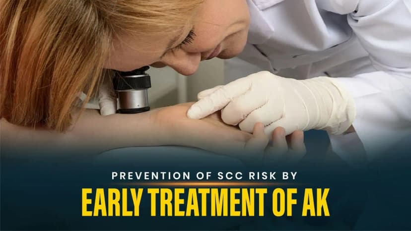 Prevention of SCC Risk by Early Treatment of AK