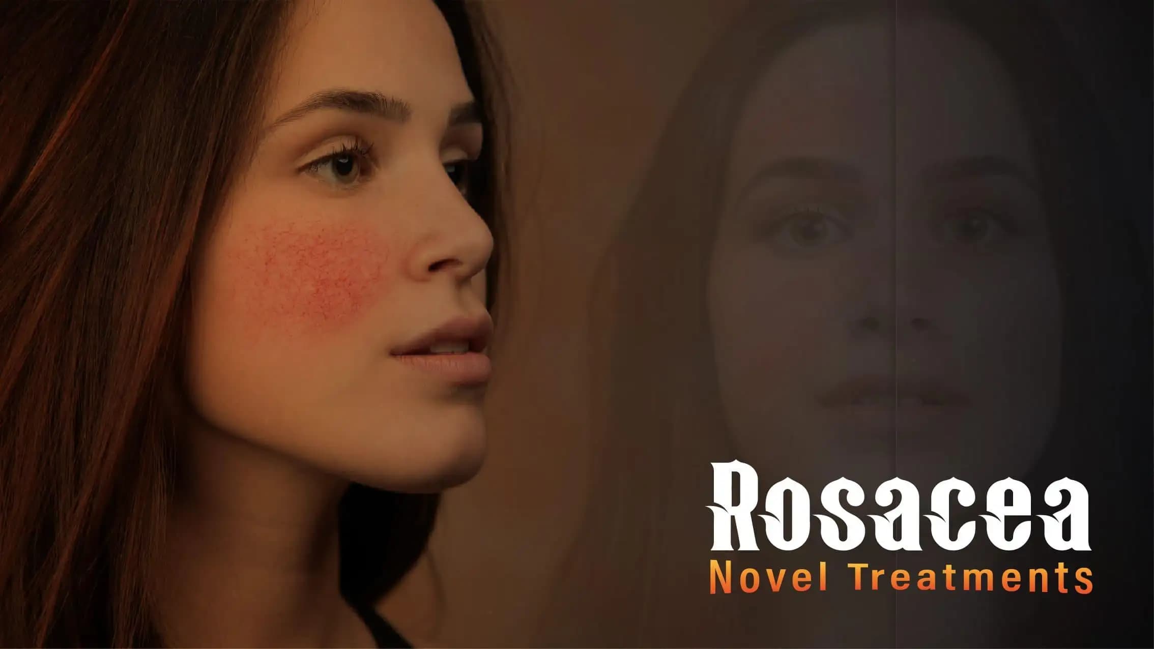 Rosacea Novel Treatments