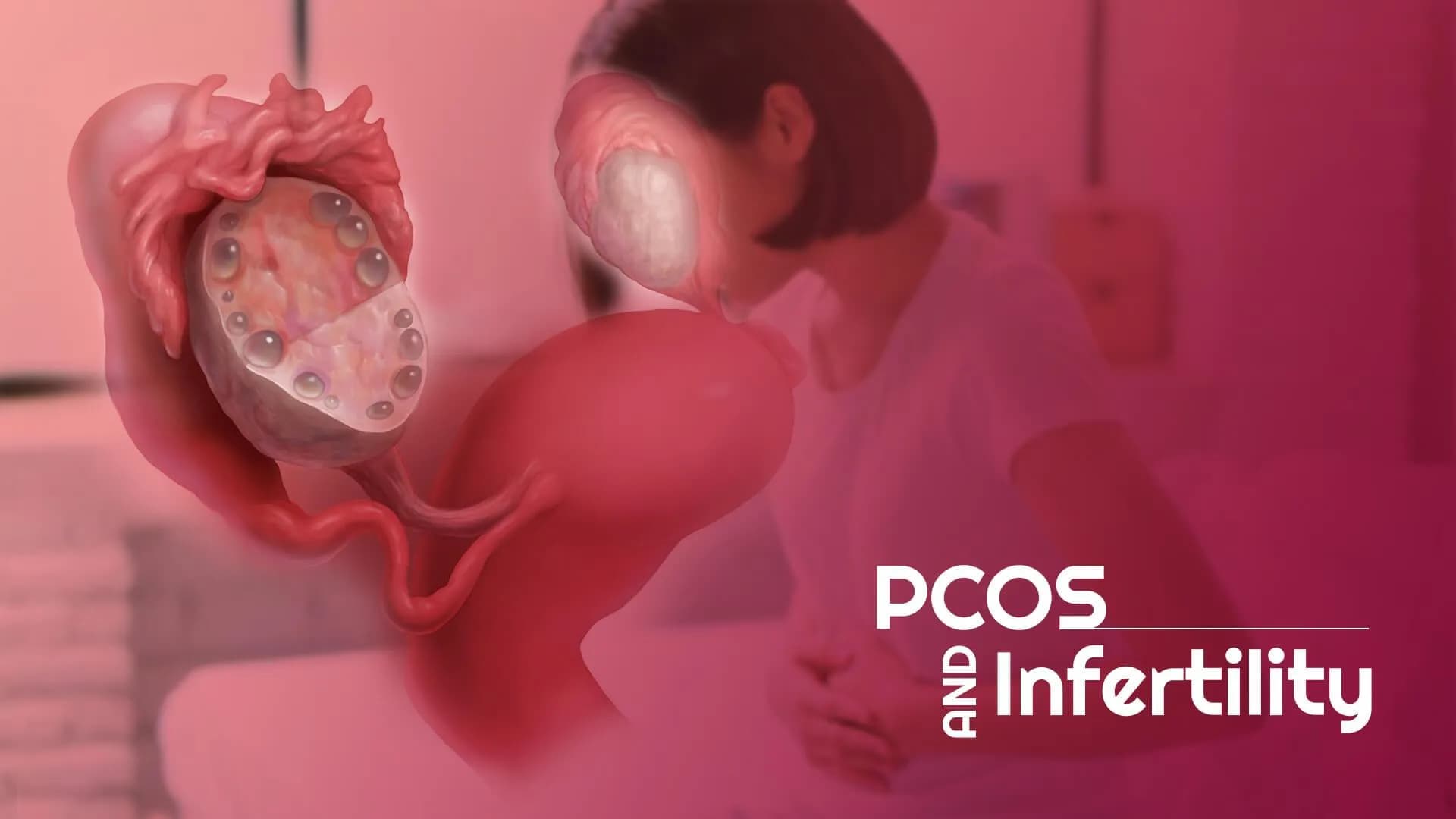 PCOS and Infertility