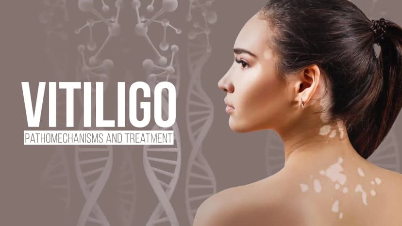 Vitiligo Pathomechanisms and Treatment