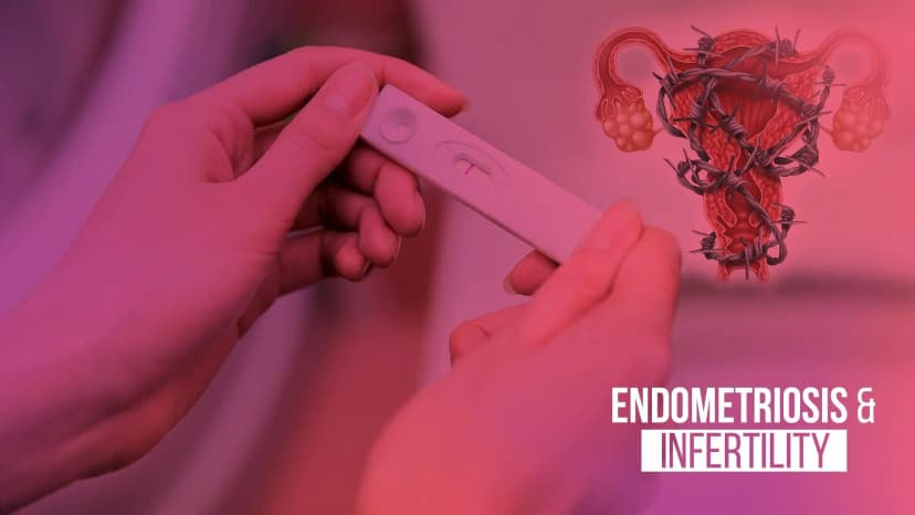 Endometriosis & Infertility