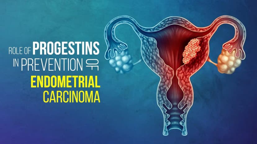 Role of Progestins in Prevention of Endometrial Carcinoma: Practical Guide to Gynaecologists