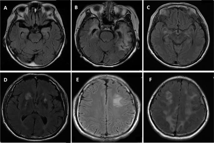 A case report of anti-DPPX encephalitis combined with neuroleptospirosis