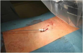 Epidural blood patching is effective for long-term SIH