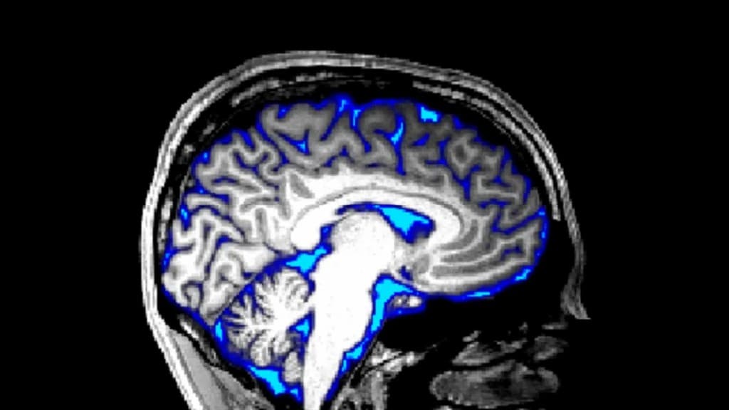 Low cerebrospinal fluid pressure tied to severe Dementia in AD cases