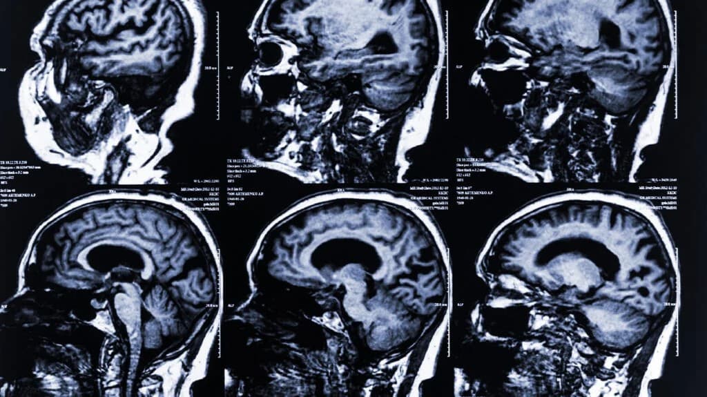 Spectrum and prevalence of non-motor symptoms in multiple system atrophy