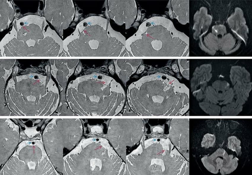 Predictors of poor prognosis in perforator artery disease stroke patients