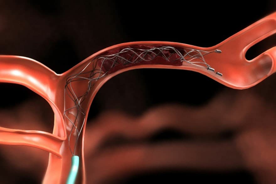 Is early RAO recanalization for neuroendovascular procedures feasible?