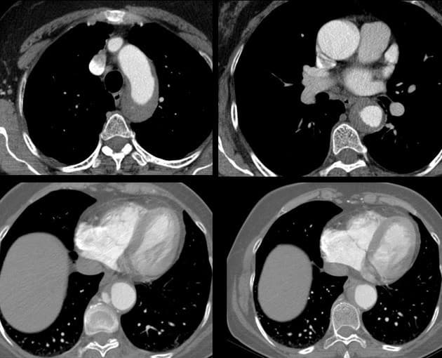 Thoracic aortic diameter linked to intracranial aneurysm risk and rupture