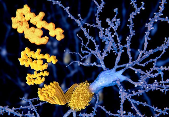 Low tau levels common in Alzheimer's cases, linked with specific impacts