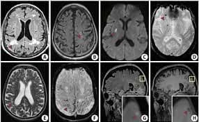 What is the role of D-Dimer in Recent Small Subcortical Infarction?