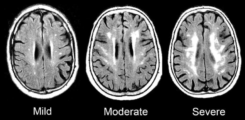 Correlation between fibrinogen, D-dimer & WMH severity in CSVD