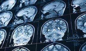 Active cancer patients with stroke have poorer outcomes and treatment rates