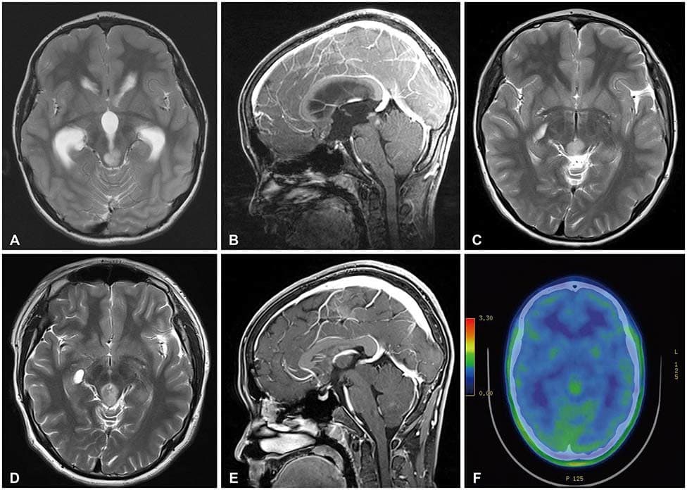 Natural history and management of Adult Tectal Plate Gliomas