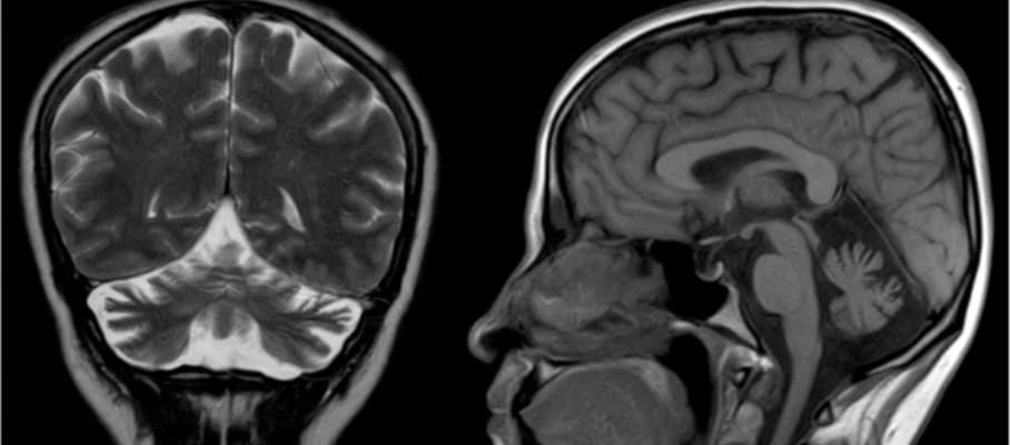 HRQoL decline in SCA: Ataxia severity & mental health key factors