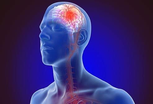 High GAR tied to increased mortality in AIS cases