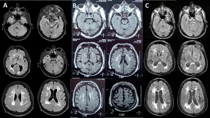 Clinical & transcranial sonography difference b/w VaP & Parkinson’s Disease