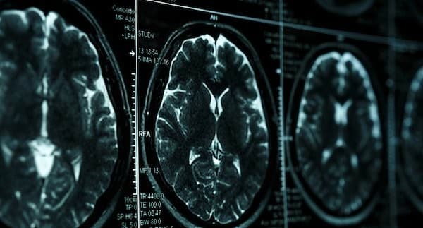 Biomarkers identified for early Tourette syndrome diagnosis