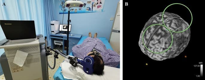 rTMS shows promise in alleviating Central Post-Stroke Pain