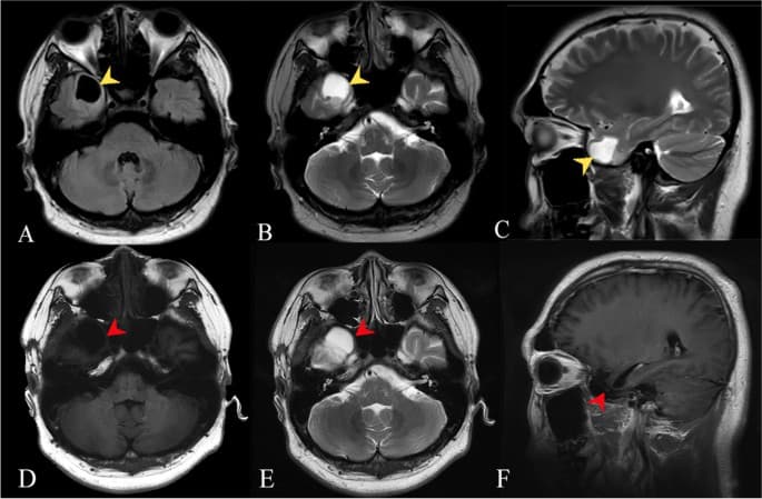 Spontaneous downbeat nystagmus: Etiology and clinical features