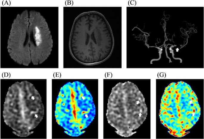 Arterial transit artifact in stroke cases associated with better outcomes