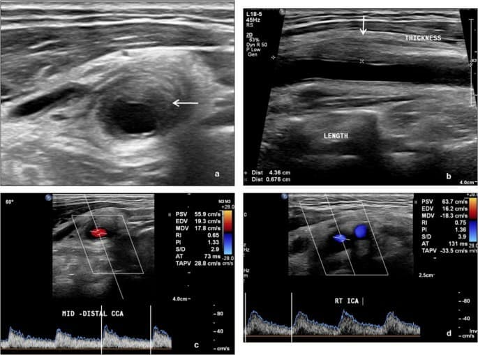 Clinical and ultrasound long-term follow-up of patients with TIPIC