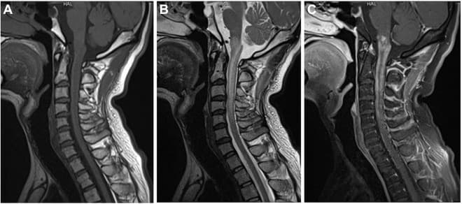 Infratentorial DAVF masquerading as cervical myelopathy: A case study