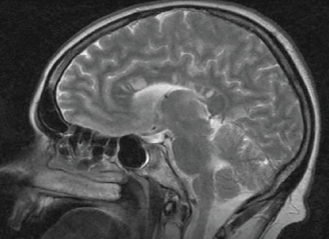 Susac syndrome patients show varied neuropsychological responses over time