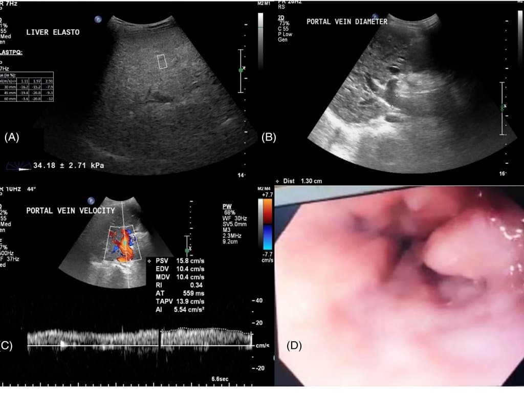Spleen elastography emerges as an excellent tool to predict risk of varices