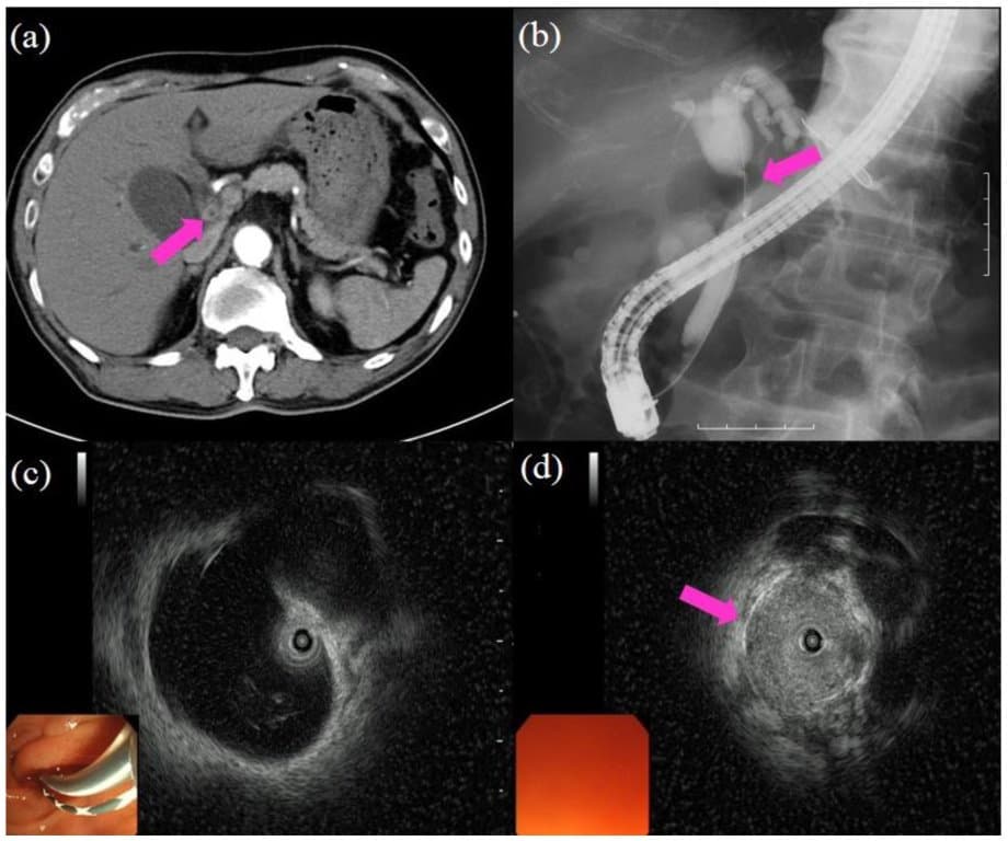 Efficacy of endoscopic biliary drainage on PA patients- study