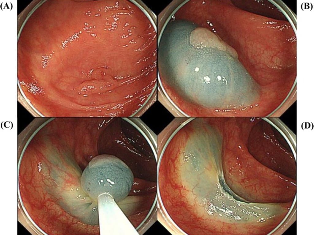 CS-EMR: a safe & effective attempt for resecting colorectal polyps ≤20 mm
