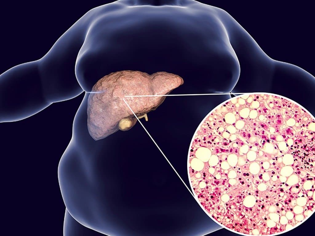 TyG Levels and Diabetes Risk in NAFLD Patients: U-Shaped Association