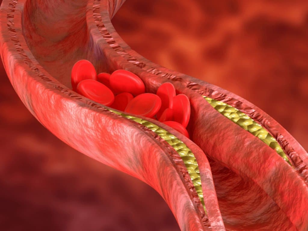 Underdiagnosed and Undertreated: Gender Gaps in ACS Management