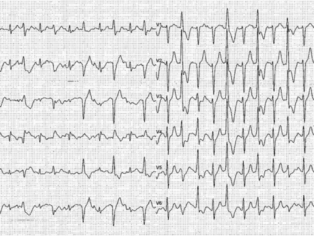 Prognostic Significance of Stress Test-Induced Arrhythmias: A Meta-Analysis