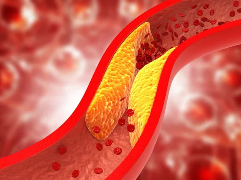 Cardiometabolic Index and ASCVD Risk: Impact of Glucose Metabolism