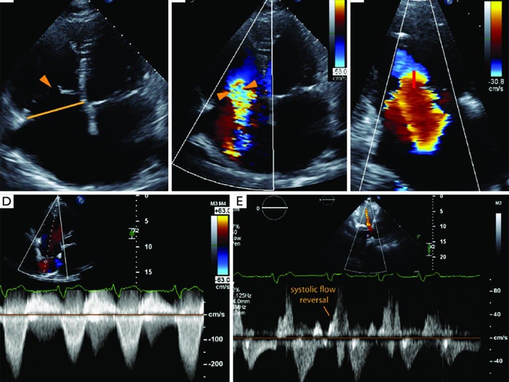 Tricuspid regurgitation impacts AF recurrence post-PVI