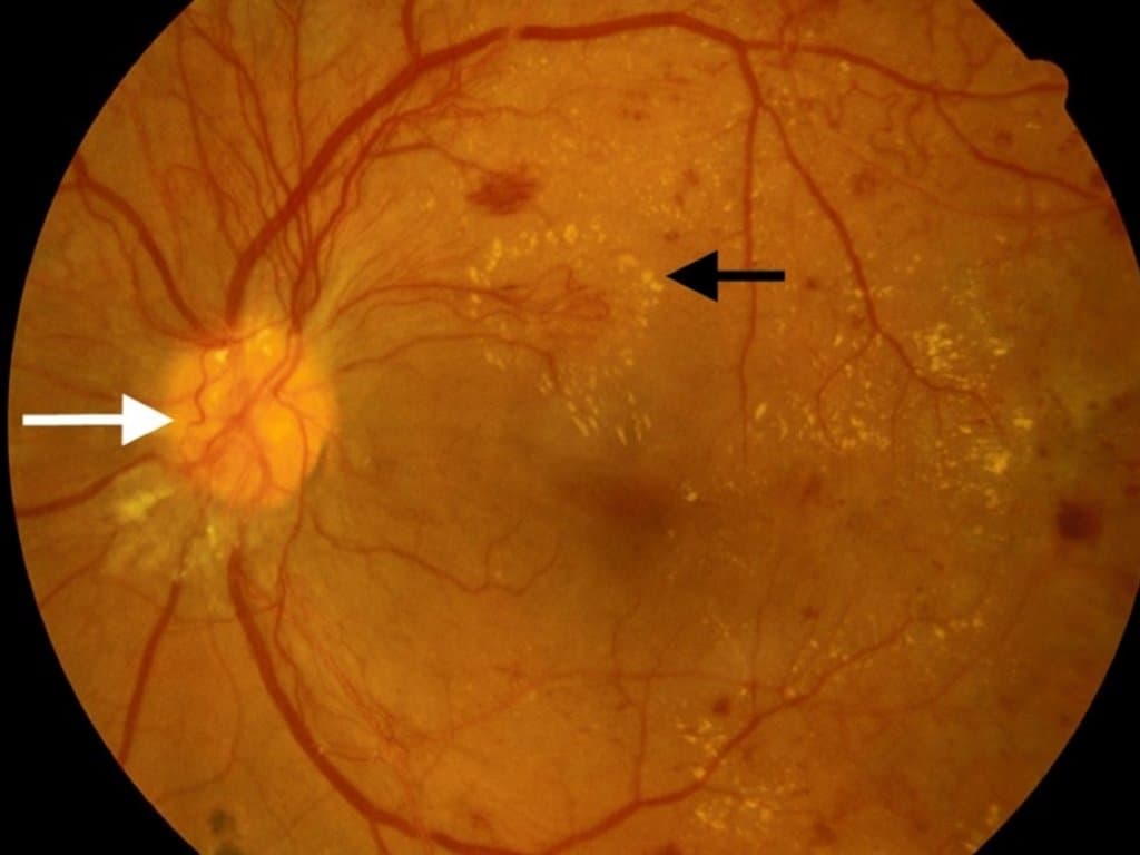 TyG Index: Independent Risk Factor for DR in T2DM Patients