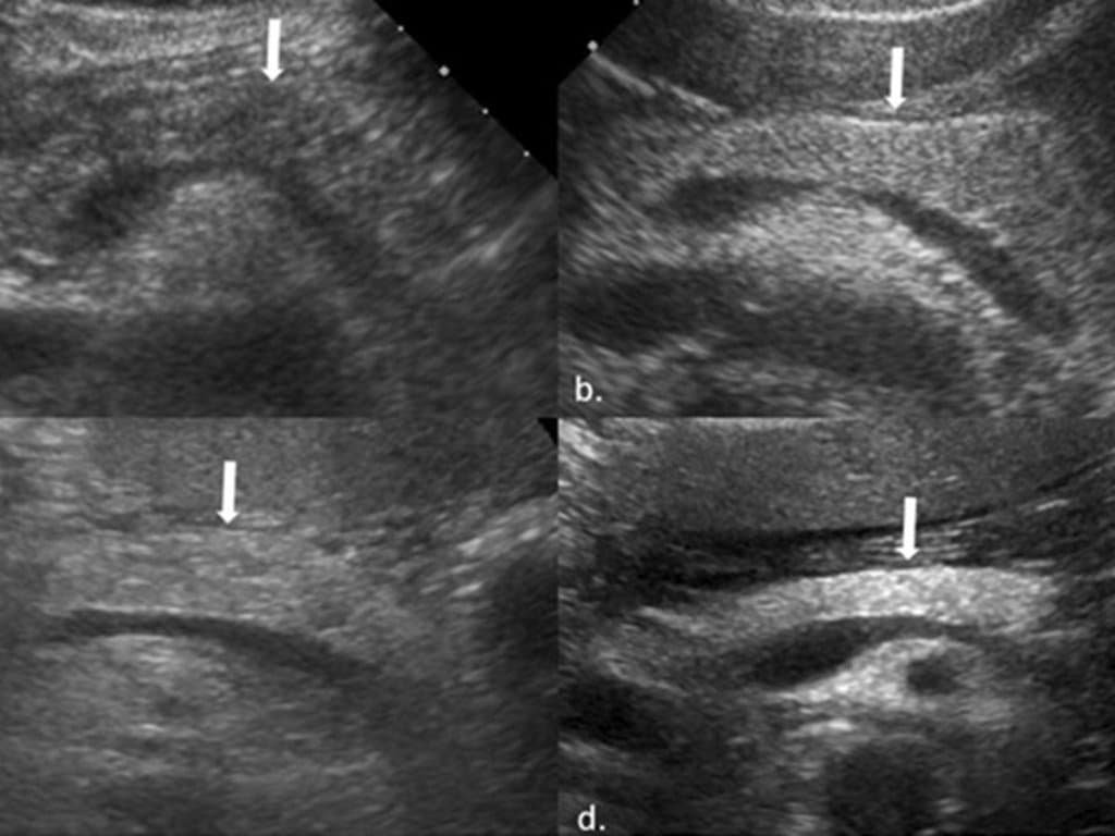 TyG index predicts fatty pancreas disease in elderly patients