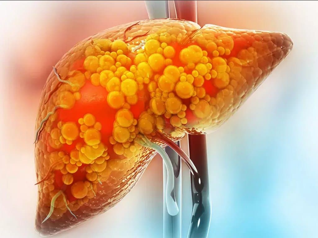 Potential of the FIB-4 index to predict LEAD risk in MASLD patients