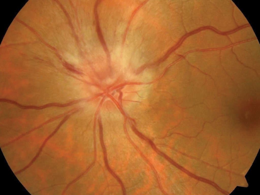 Semaglutide use linked to increased risk of NAION in T2DM patients