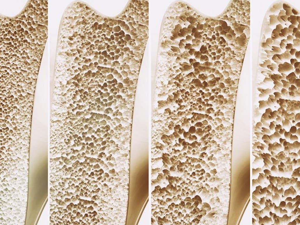 Synergistic effect of smoking and osteoporosis on all-cause mortality risk