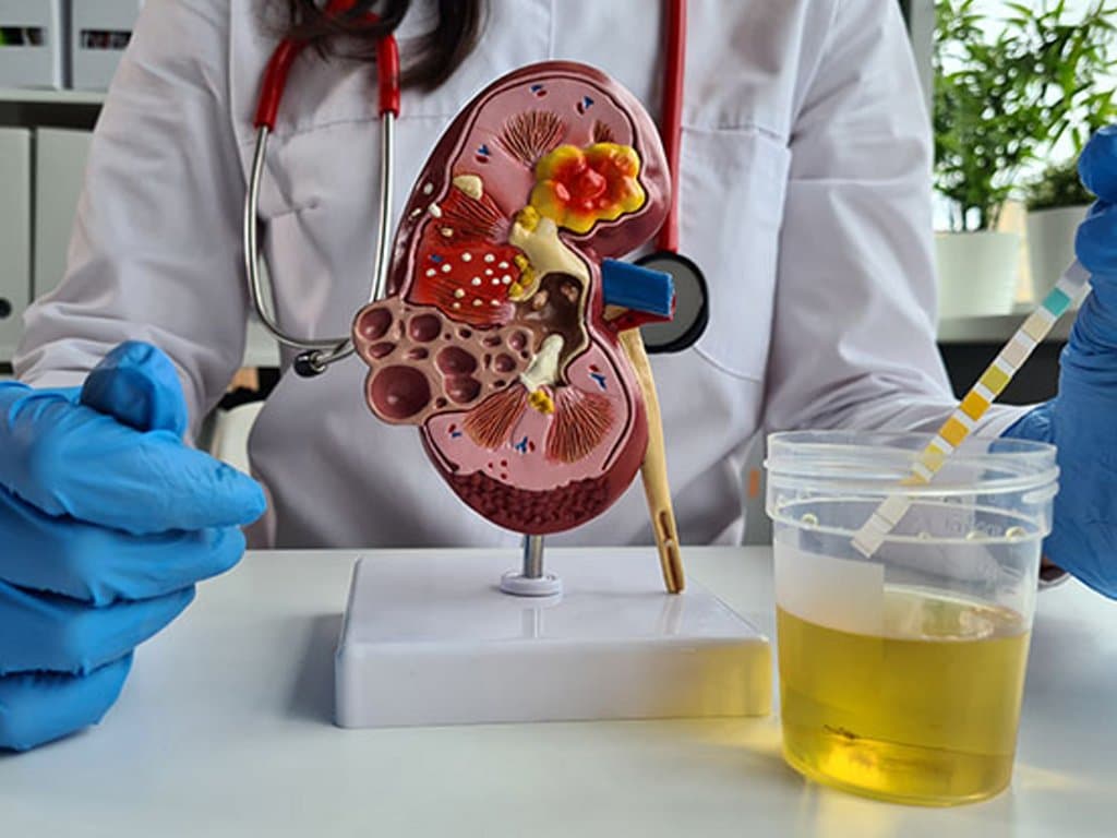 Renal glucosuria is associated with hematocrit and uric acid changes