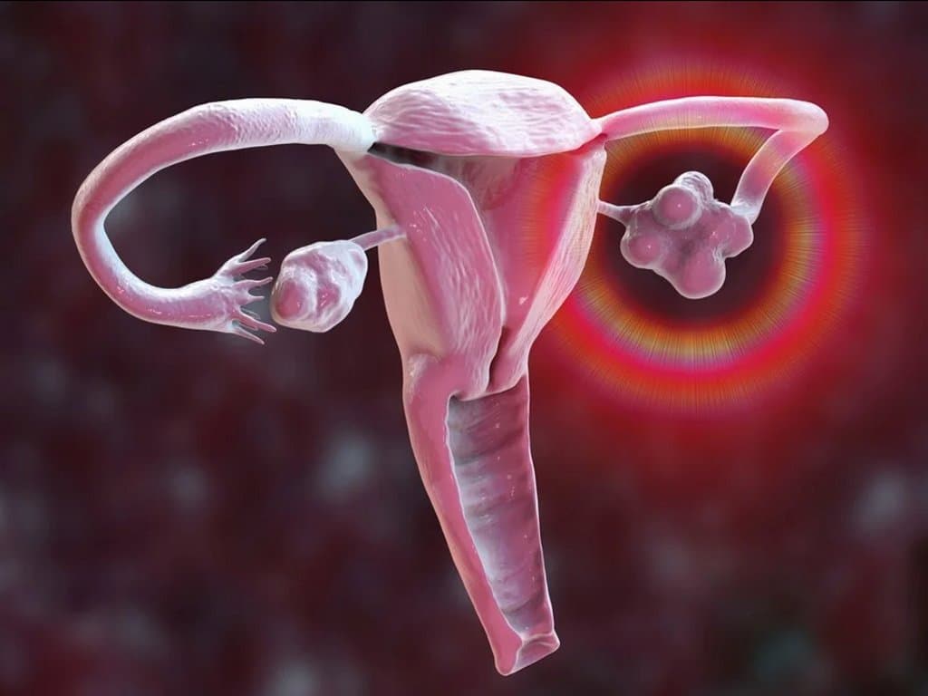 Subclinical hypothyroidism worsens insulin resistance in women with PCOS